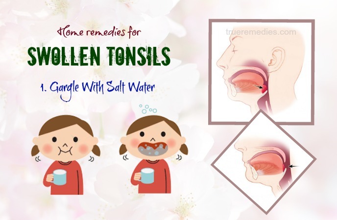 64 Home Remedies For Swollen Tonsils Pain White Patches