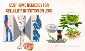 home remedies for cellulitis
