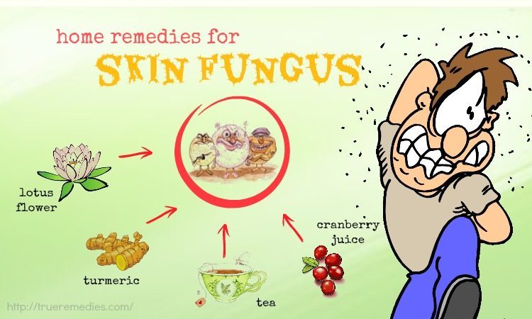 home remedies for skin fungus