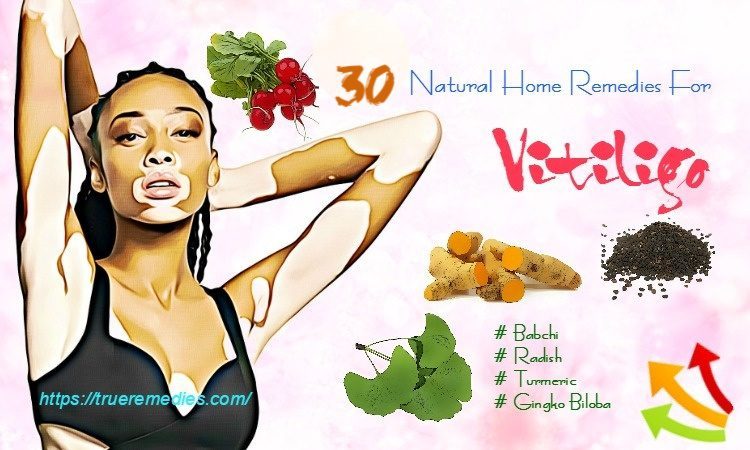 home remedies for vitiligo
