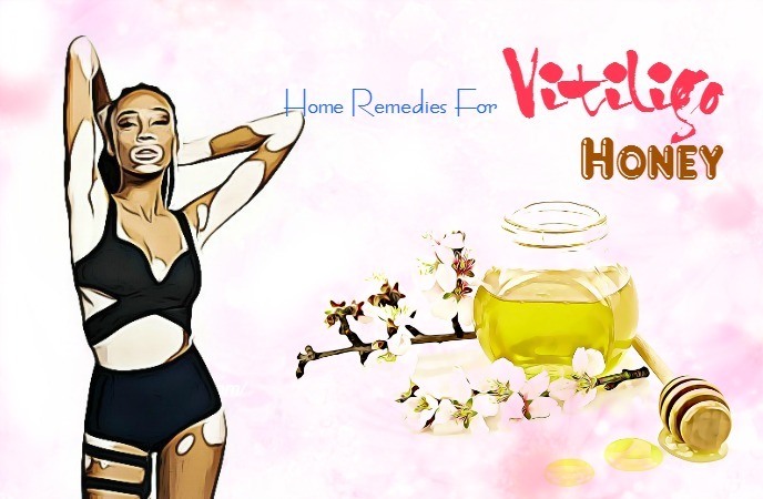 home remedies for vitiligo - honey