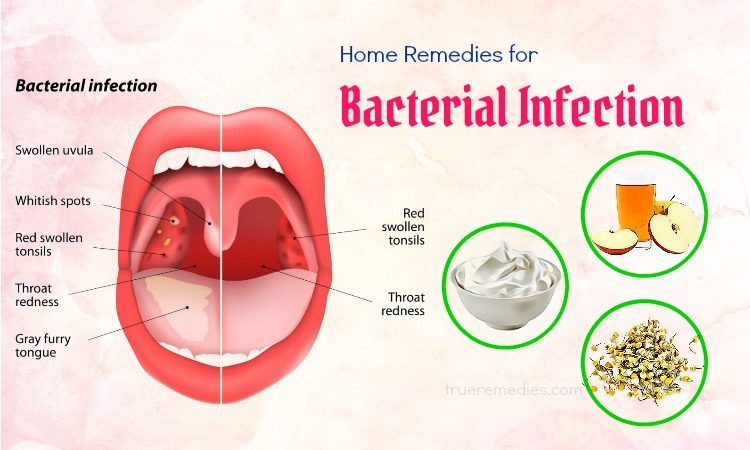 home remedies for bacterial infection