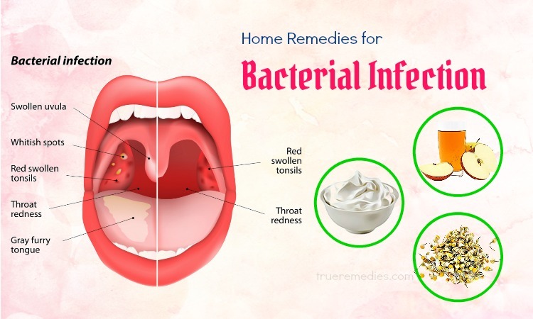 how to treat a bacterial infection in the mouth