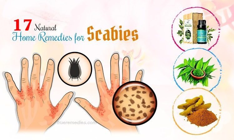 home remedies for scabies