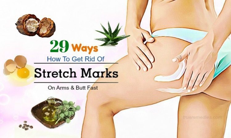 how to get rid of stretch marks