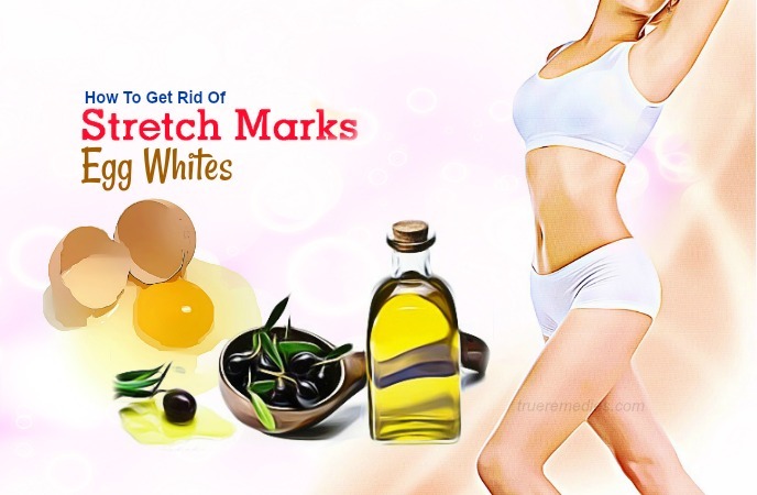 how to get rid of stretch marks