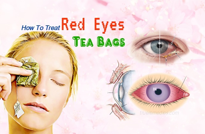 how to treat red eyes