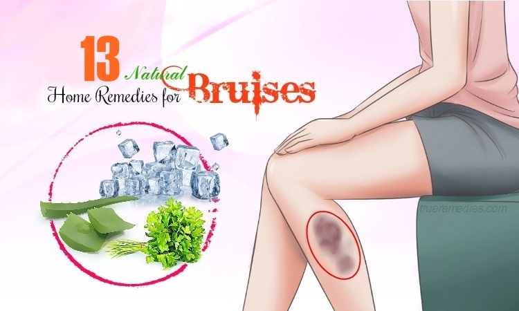 home remedies for bruises