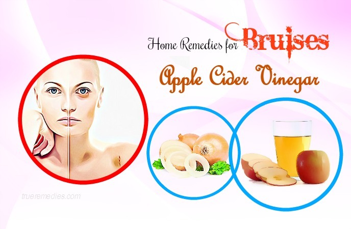 home remedies for bruises - apple cider vinegar