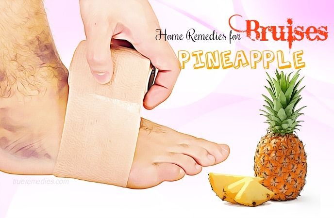 home remedies for bruises - pineapple