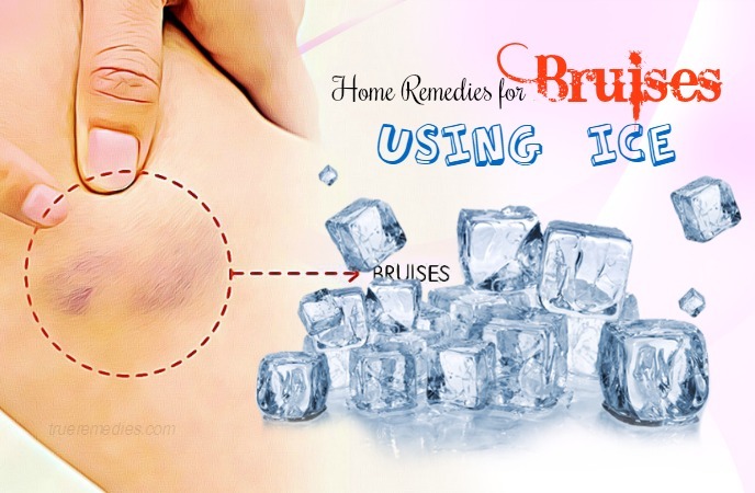 home remedies for bruises 