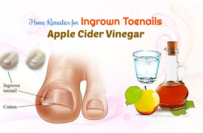 14-home-remedies-for-ingrown-toenails-infection-fungus