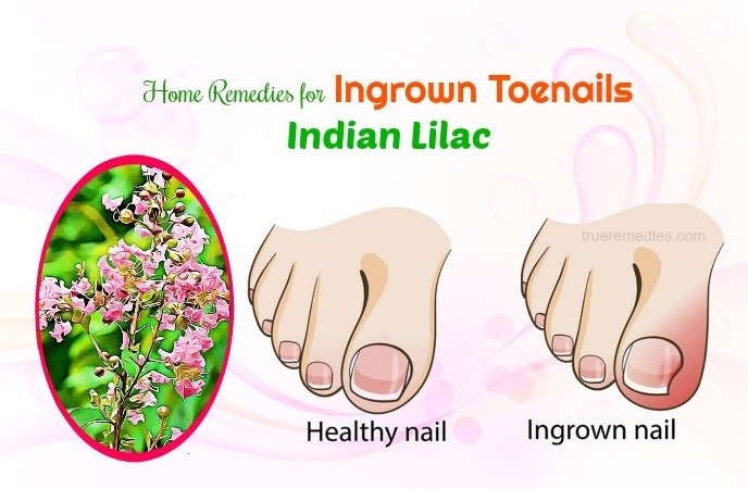 home remedies for ingrown toenails - indian lilac