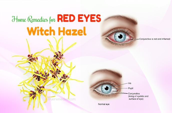 home remedies for red eyes 