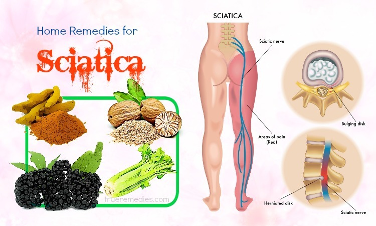 19 Natural Home Remedies For Sciatica Pain Relief.