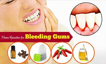 home remedies for bleeding gums