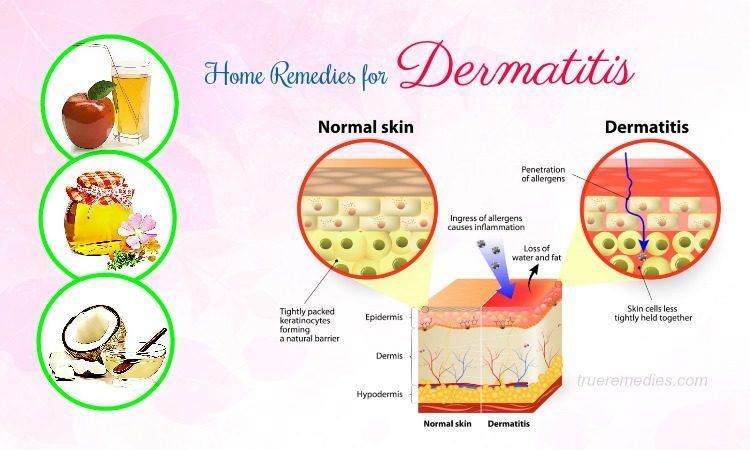home remedies for dermatitis