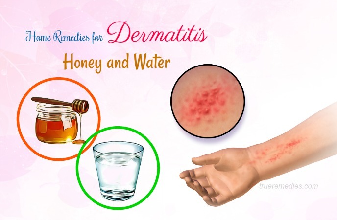 home remedies for dermatitis 