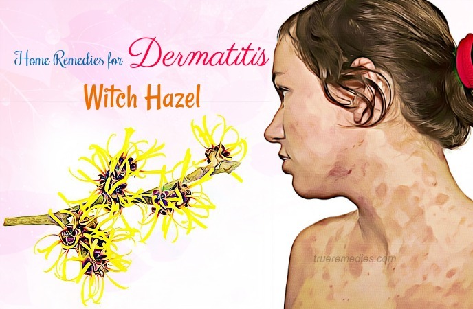 home remedies for dermatitis - witch hazel