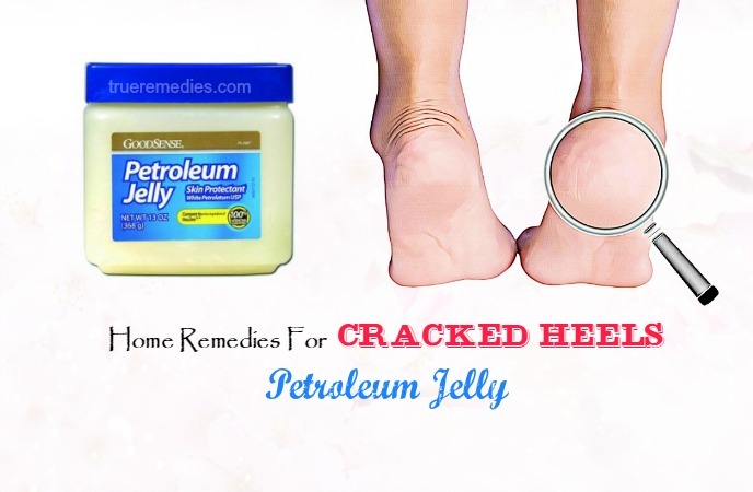 home remedies for cracked heels 