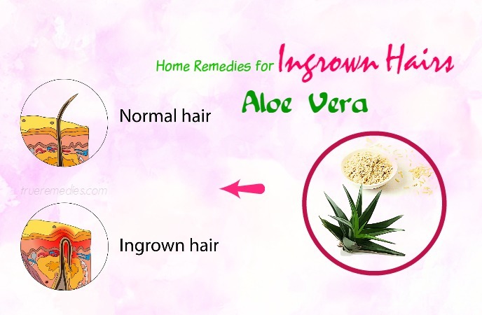 home remedies for ingrown hairs 