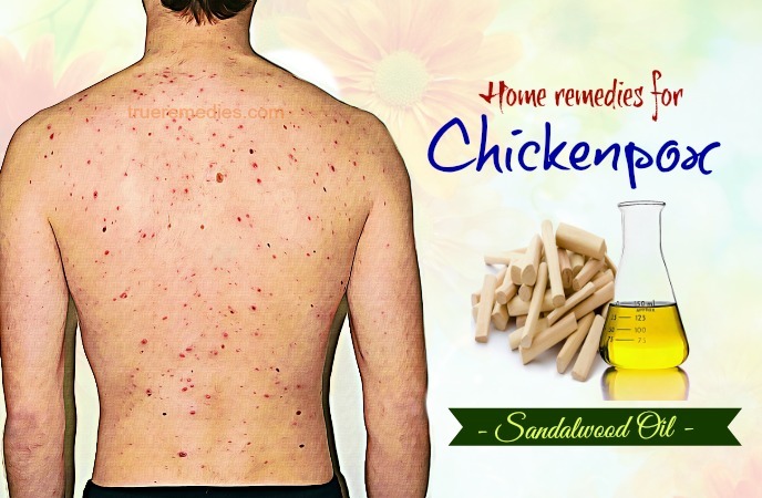 home remedies for chickenpox - sandalwood oil
