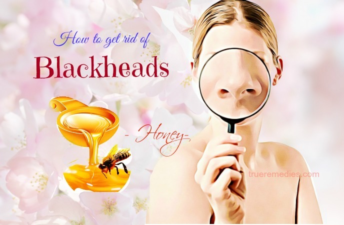 how to get rid of blackheads