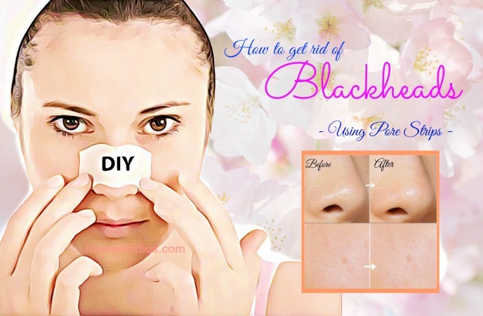 how to get rid of blackheads 