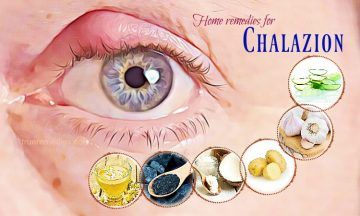 home remedies for chalazion