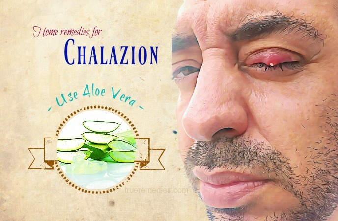 home remedies for chalazion