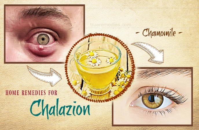 warm eye compress for chalazion