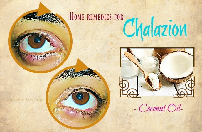 home remedies for chalazion - coconut oil