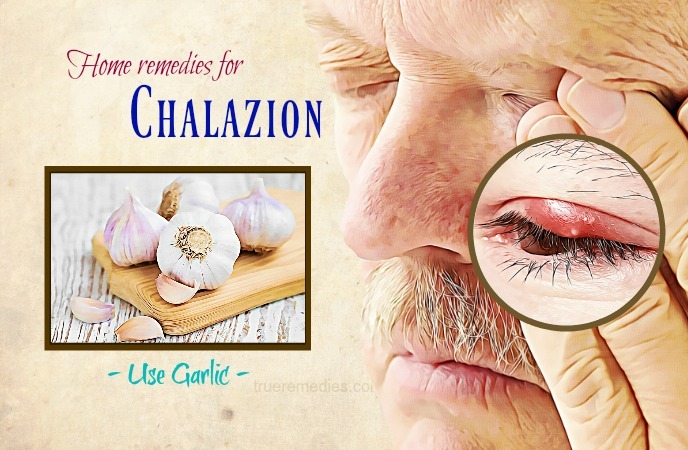 38 Natural Home Remedies For Chalazion Cysts On The Eyelid 