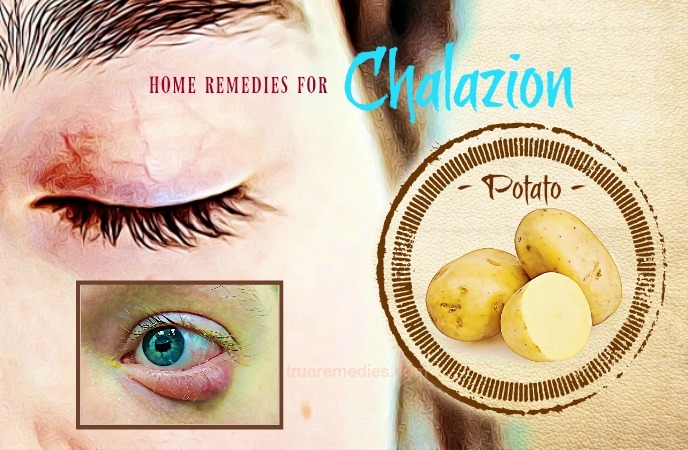 home remedies for chalazion - potato