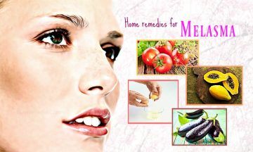 home remedies for melasma