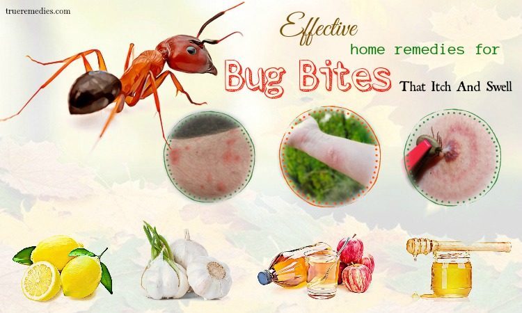 home remedies for bug bites that itch