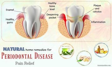 natural home remedies for periodontal disease