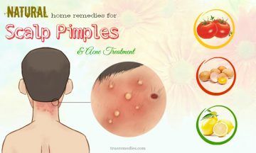 natural home remedies for scalp pimples