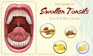 home remedies for swollen tonsils with white p