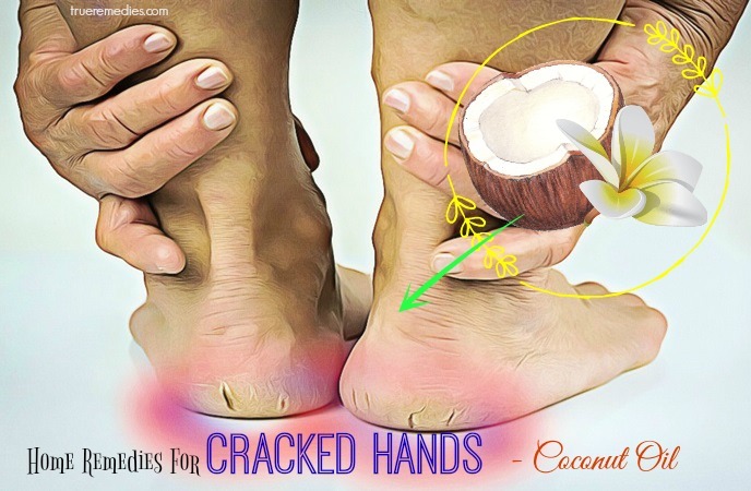 home remedies for cracked hands - coconut oil