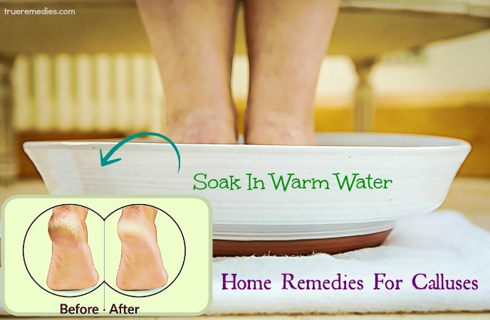 home remedies for calluses - soak in warm water