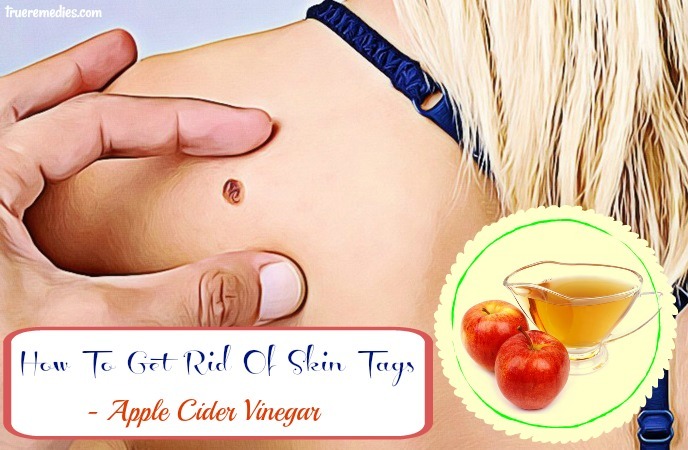 how to get rid of skin tags - apple cider vinegar