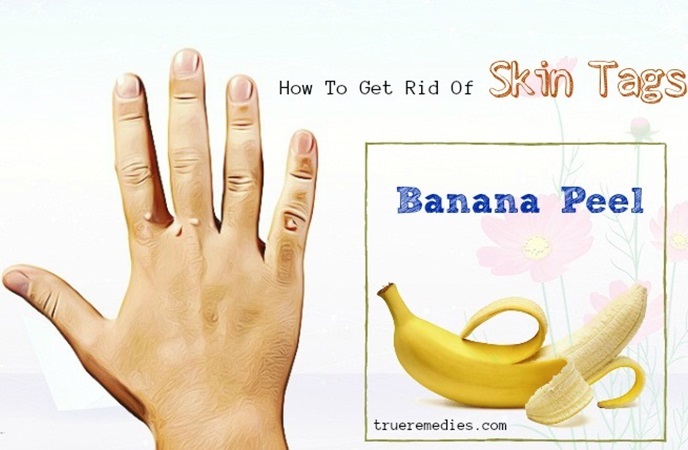 how to get rid of skin tags - banana peel