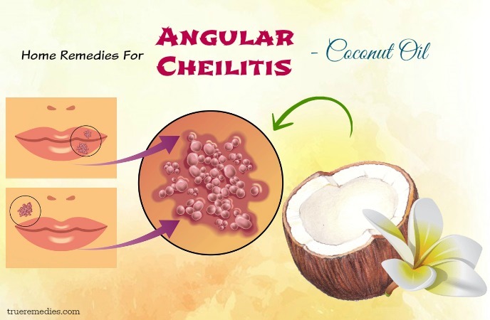 home remedies for angular cheilitis - coconut oil