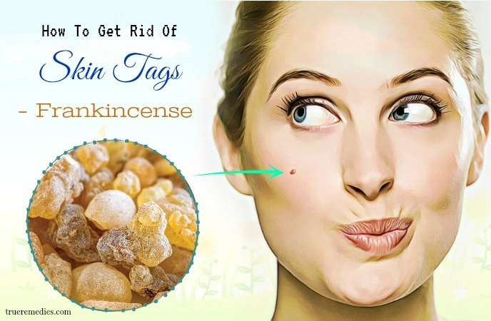 how to get rid of skin tags - frankincense