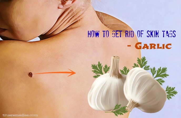 how to get rid of skin tags - garlic