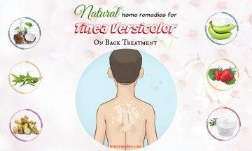 natural home remedies for tinea versicolor
