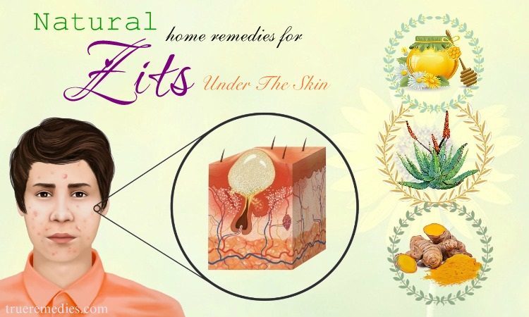 natural home remedies for zits