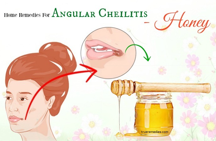 home remedies for angular cheilitis - honey