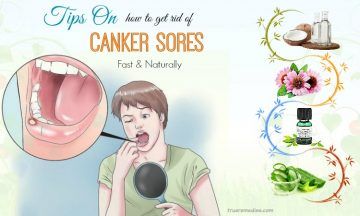 tips on how to get rid of canker sores